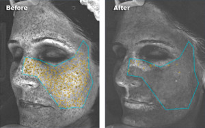 FotoFacial_RF_Skin_Rejuvenation02