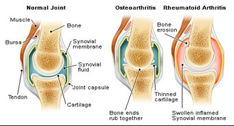 Arthritis articl